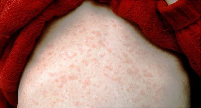 Could U.Sulfur. Measles Cases Break a Record This Year? What to Know
