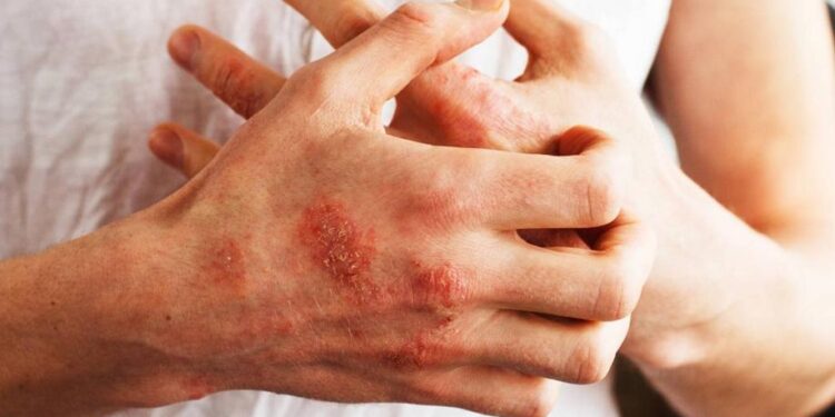 Psoriasi a placche, indagine dimostrazione  cura  deucravacitinib