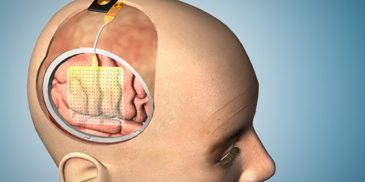 This new brain-mapping device could make neurosurgery safer : Shots