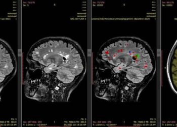 Sydney Neuroimaging Analysis Centre bags grant for dementia, multiple sclerosis analysis AI