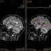 Sydney Neuroimaging Analysis Centre bags grant for dementia, multiple sclerosis analysis AI