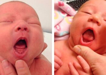 Tongue Tie May Be Overdiagnosed per mezzo di Babies