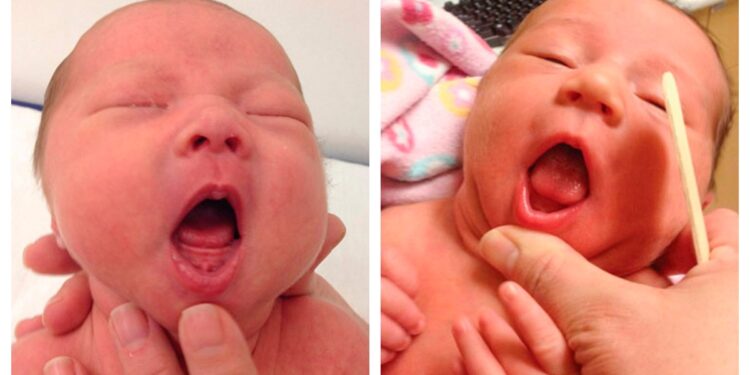 Tongue Tie May Be Overdiagnosed per mezzo di Babies