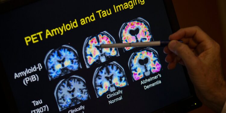 Blood Tests for Alzheimer’s May Be Coming to Your Doctor’s Office
